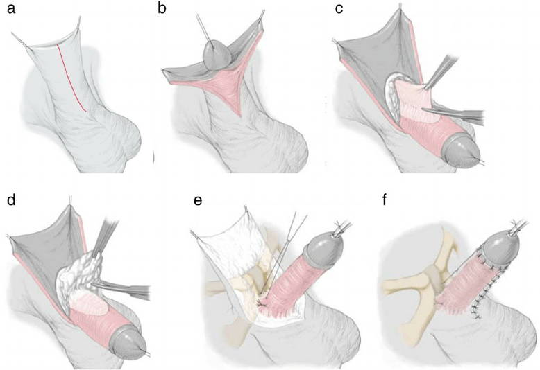 penis büyütme için ligamanotomi